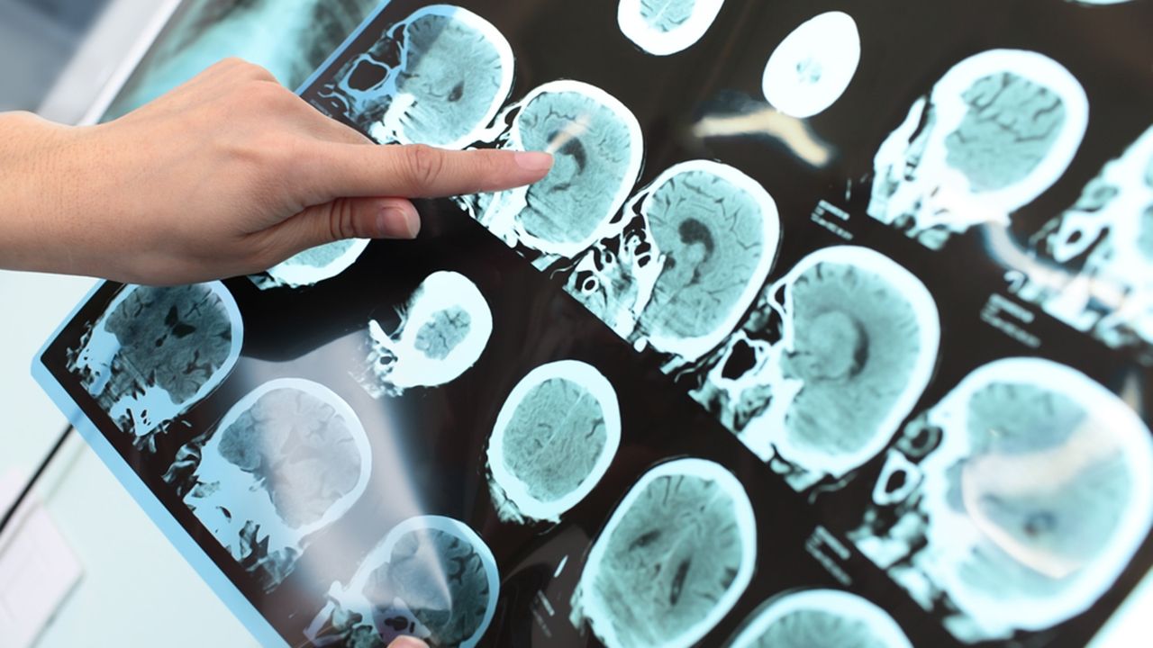 cerebro exame alzheimer canabinoide