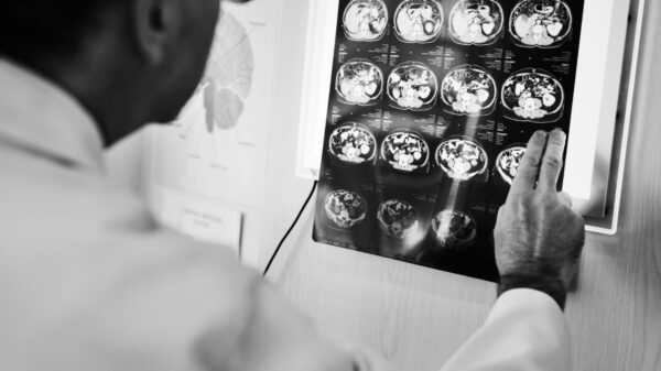 Acidente Vascular Cerebral (AVC)