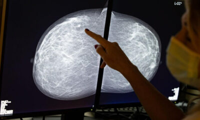 Tomossíntese mamografia câncer de mama