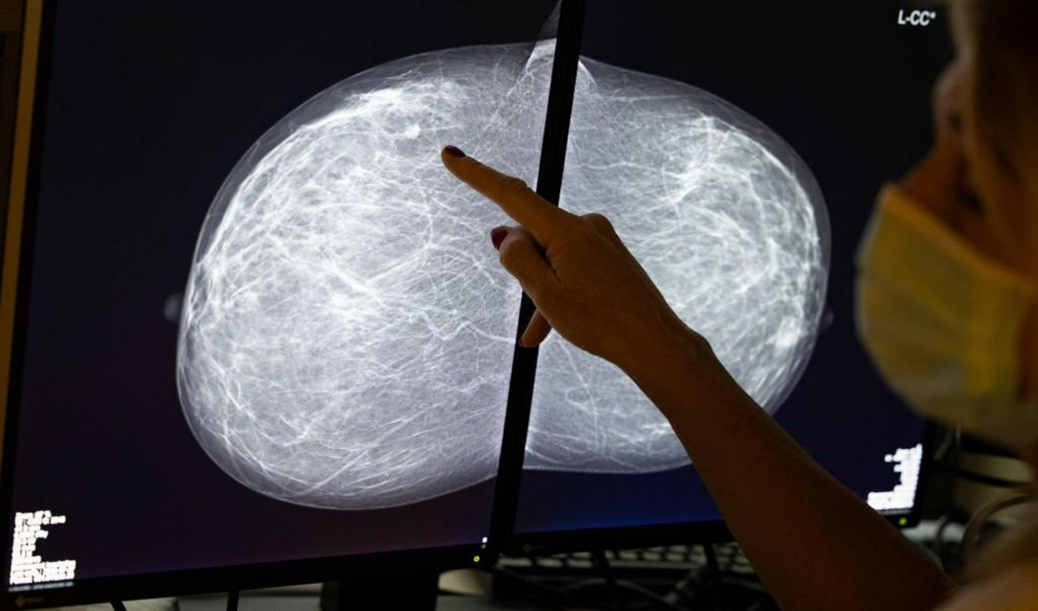 Tomossíntese mamografia câncer de mama