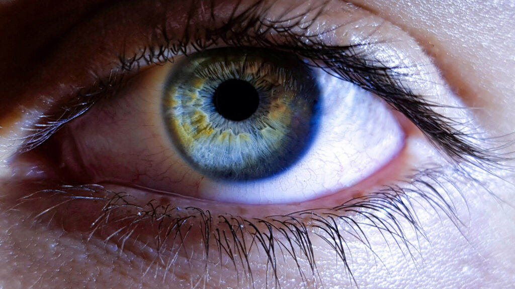 glaucoma