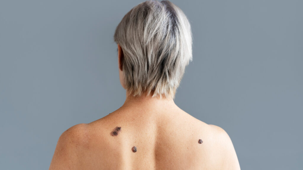 Câncer de pele não melanoma