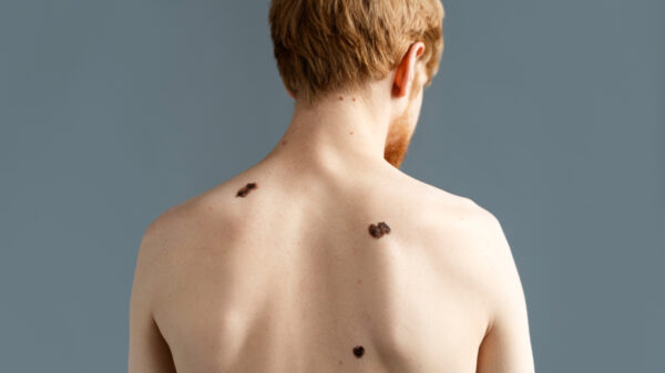 Melanoma - Câncer de pele - Dezembro Laranja