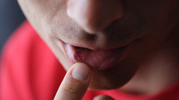 Novembro Vermelho Câncer de Boca