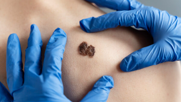 câmcer de pele - Dezembro Laranja