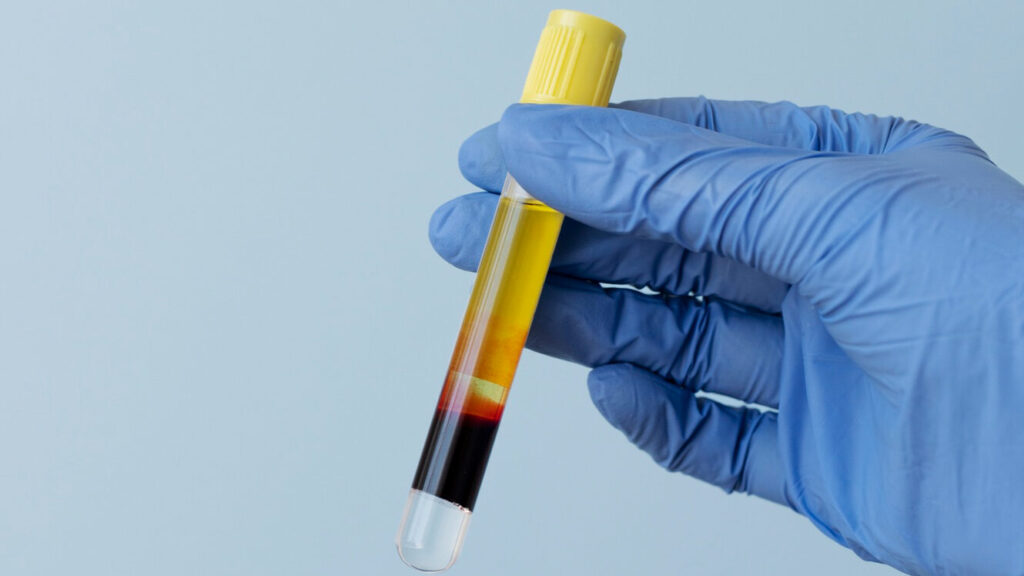 exame de sangue - câncer de próstata