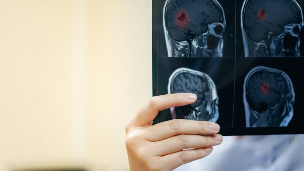 Acidente Vascular Cerebral (AVC)