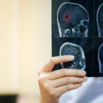 Acidente Vascular Cerebral (AVC)