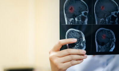 Acidente Vascular Cerebral (AVC)