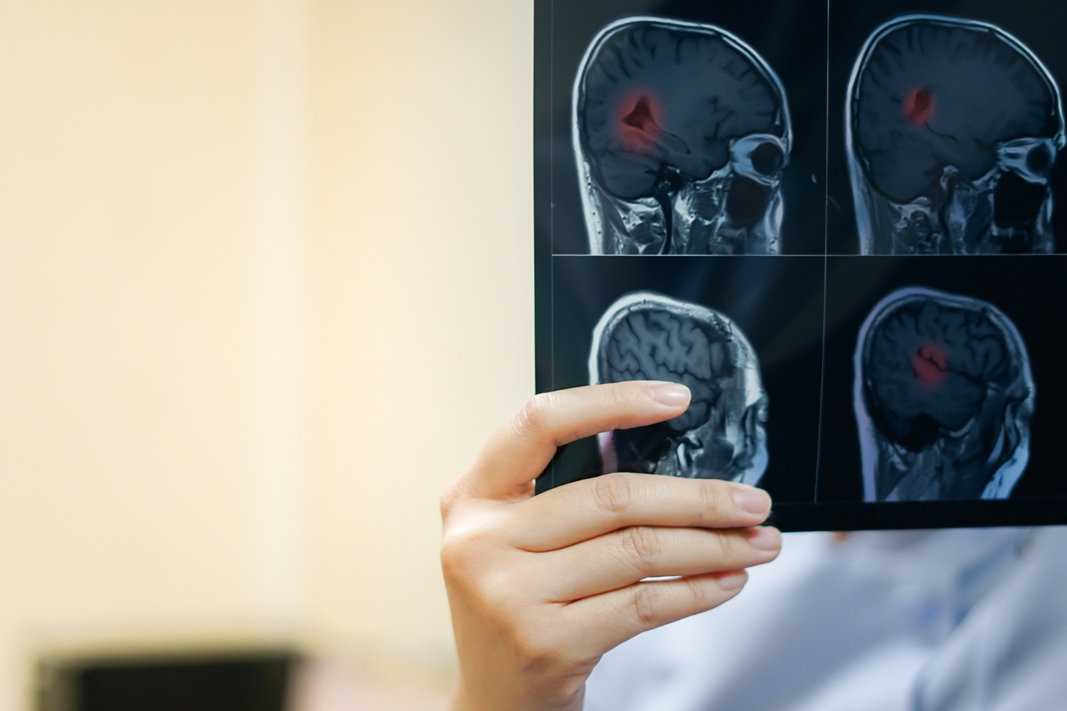 Acidente Vascular Cerebral (AVC)