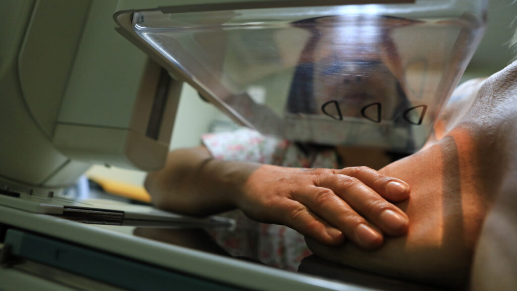 mamografia câncer de mama