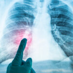 Tuberculose
